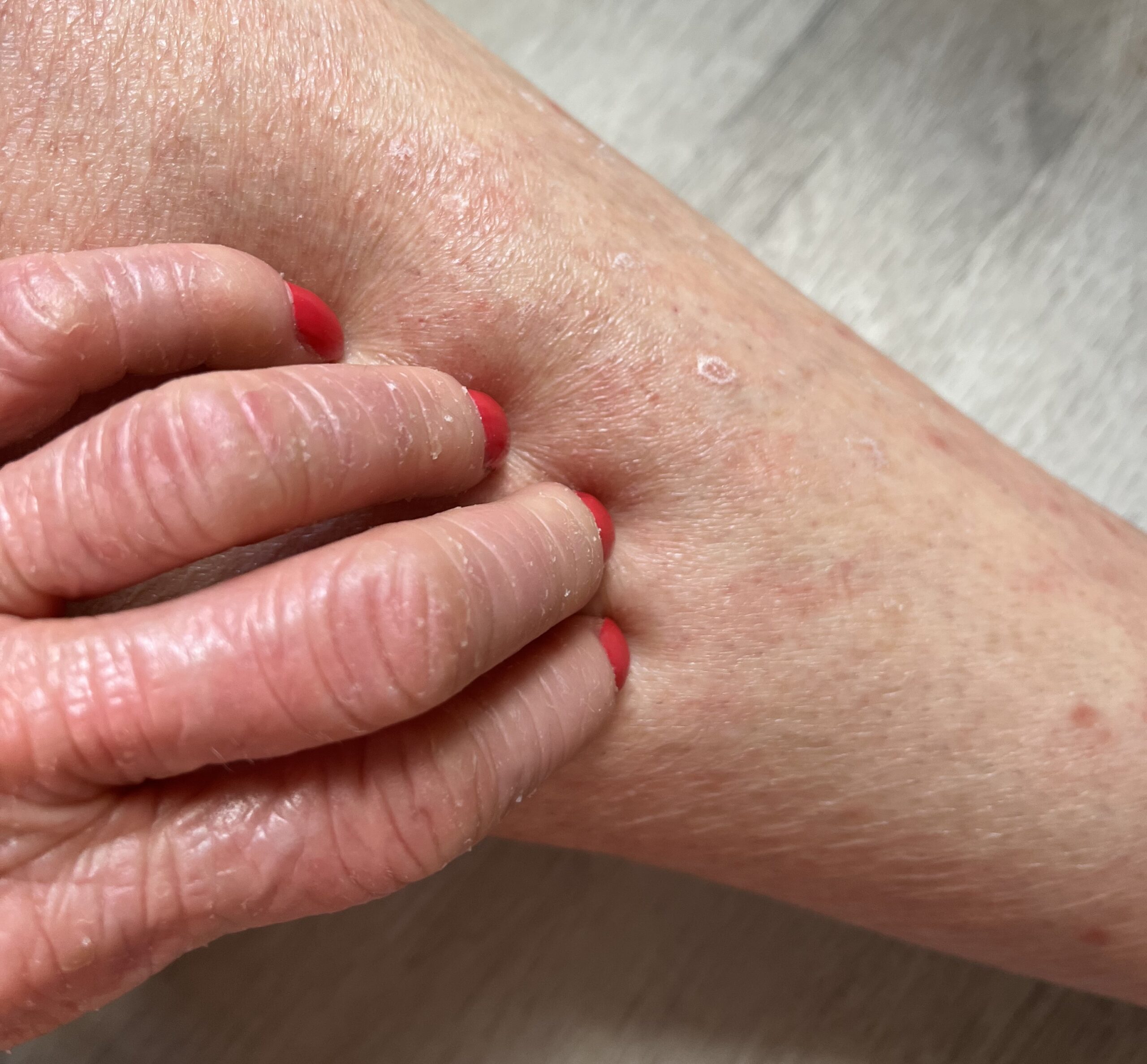 Symptoms and Complications