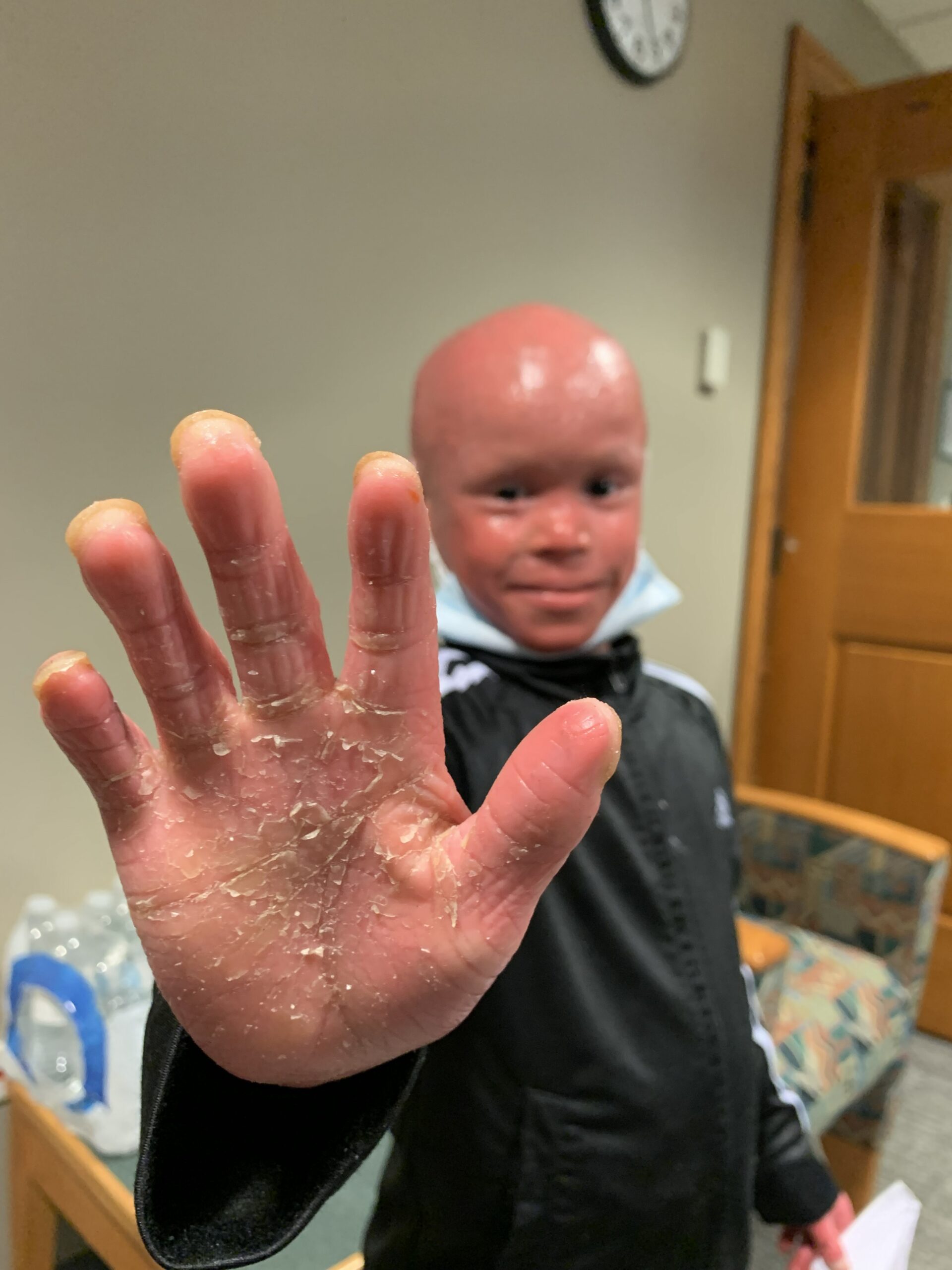 Harlequin Ichthyosis FIRST Foundation For Ichthyosis Related Skin Harlequin Ichthyosis FIRST Foundation For Ichthyosis Related Skin